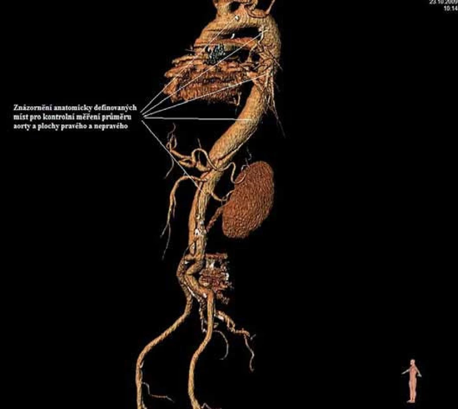 Znázornění anatomicky definovaných míst pro kontrolní měření průměru aorty a plochy pravého a nepravého kanálu direkce.