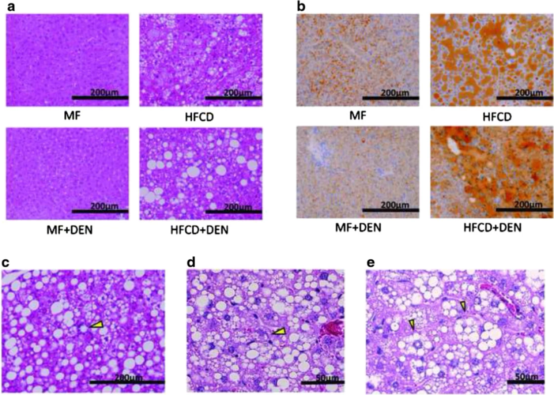 Representative images of stained liver sections: a 12 weeks with hematoxylin-eosin staining; b 12 weeks with Sudan staining; c–e 16 weeks in HFCD + DEN mice with hematoxylin-eosin staining. The original magnification is × 200 (a–c) and × 400 (d). Lipogranuloma (c), a Mallory-Denk body (d), and hepatocyte ballooning (e) are indicated by yellow arrowheads. MF, standard diet; HFCD, high-fat choline-deficient diet; DEN, diethylnitrosamine