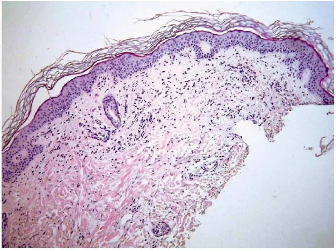 Erythema gyratum repens – histologický obraz
Perivaskulární malé infiltráty z lymfocytů s příměsí eozinofilů v horním koriu (HE, původní zvětšení 200krát).