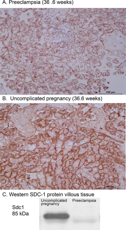 Representative images of Sdc1 immunoreactivity in preeclampsia (A) compared to uncomplicated pregnancy (B) villous tissue. Note the more intense staining on syncytiotrophoblast of uncomplicated pregnancy (immunohistochemical score = 4) compared to preeclampsia (score = 1), and apparent absence of staining in fetal villous vasculature throughout. Gestational age at delivery was 36.6 weeks for both placentas. C: Sample Western blot of villous tissue homogenates from the preeclampsia and control patients; band densities at the expected 85 kDa are consistent with reduced Sdc1 protein mass in preeclampsia. See also Table 3 for summary group data.