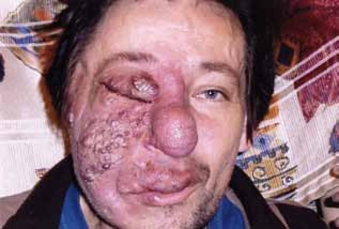 Angiomatóza obličeje – snímek v průběhu léčby po odstranění části hemangiomu u nosu. V důsledku léčby ustalo spontánní krvácení a krvácení při malém traumatu a to umožnilo první operační zákrok a histologické hodnocení.