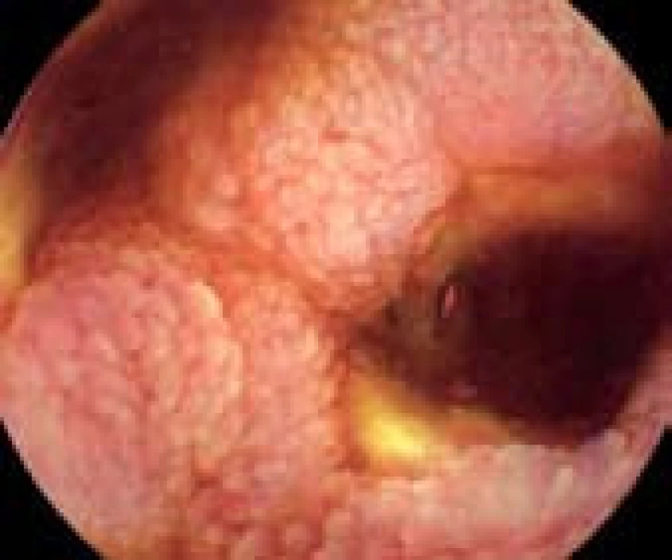 Stenóza anastomózy po resekci ilea s ulcerací.
Fig. 4. Stenosis of the anastomosis after ileal resection with ulcera.