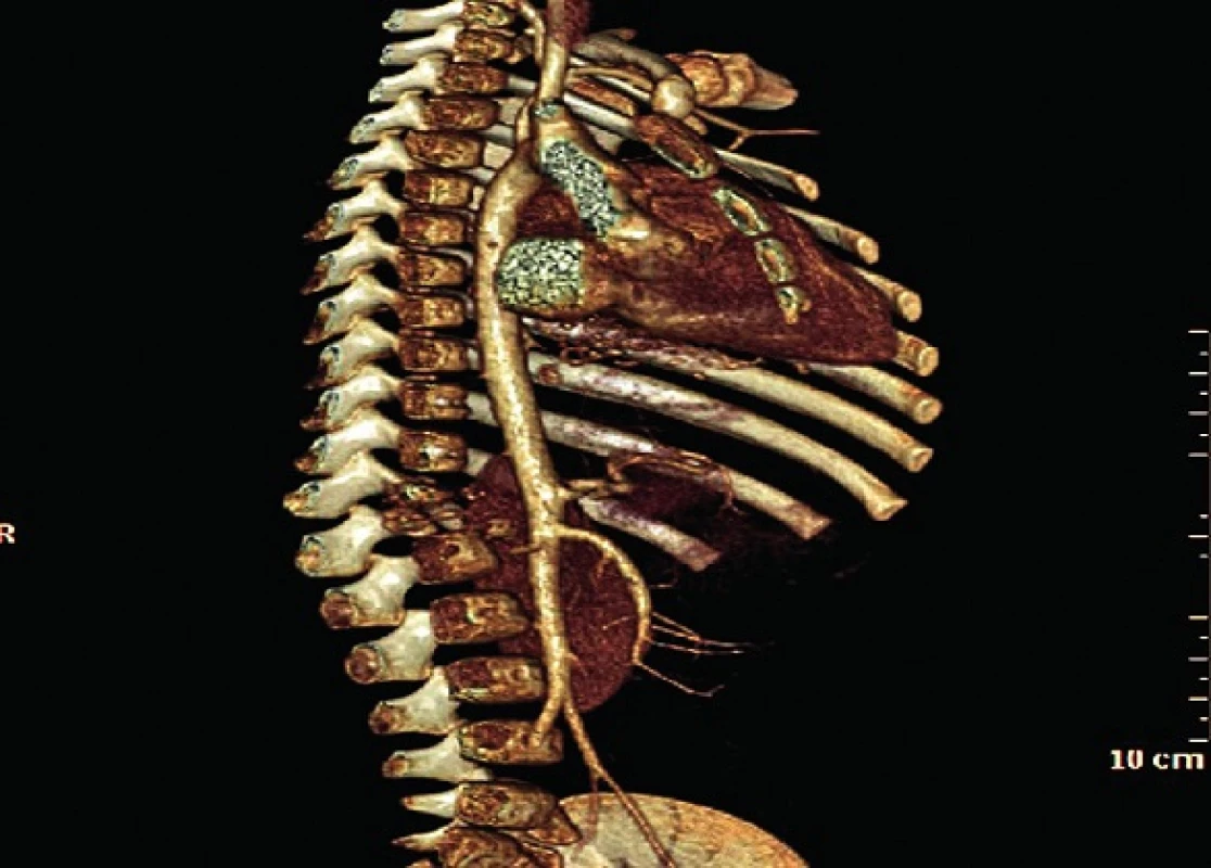 Spondylodiscitída Th12–L1 so zbortením tiel, rekonštrukčné snímky.
Fig. 5. Spondylodiscitis Th12-L1 with collapse of vertebras, remodelling scan.
