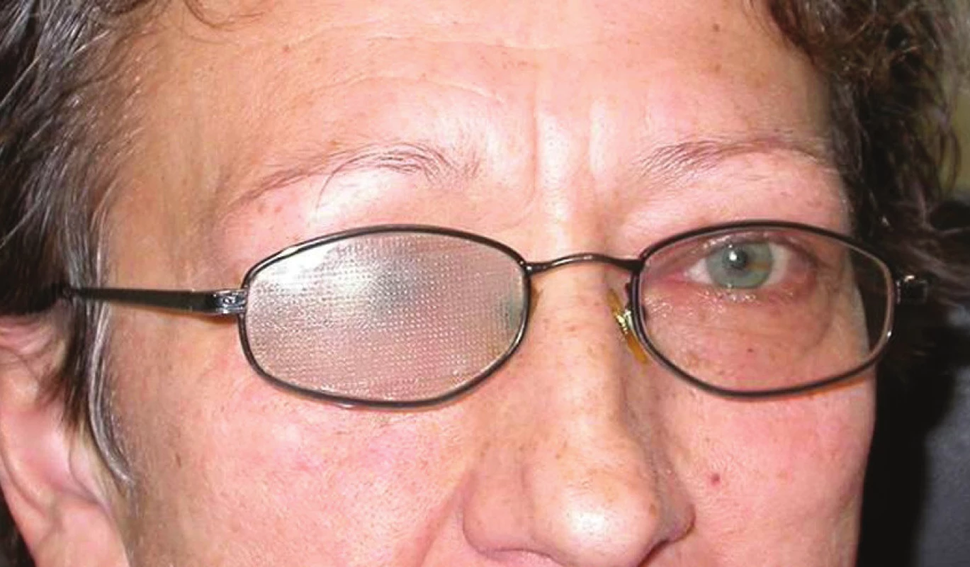 a,b Semitransparentní náplast si pacienti sami lepí na brýlové sklo. Mohou ji dle potřeby stříhat a použít i pro částečnou okluzi