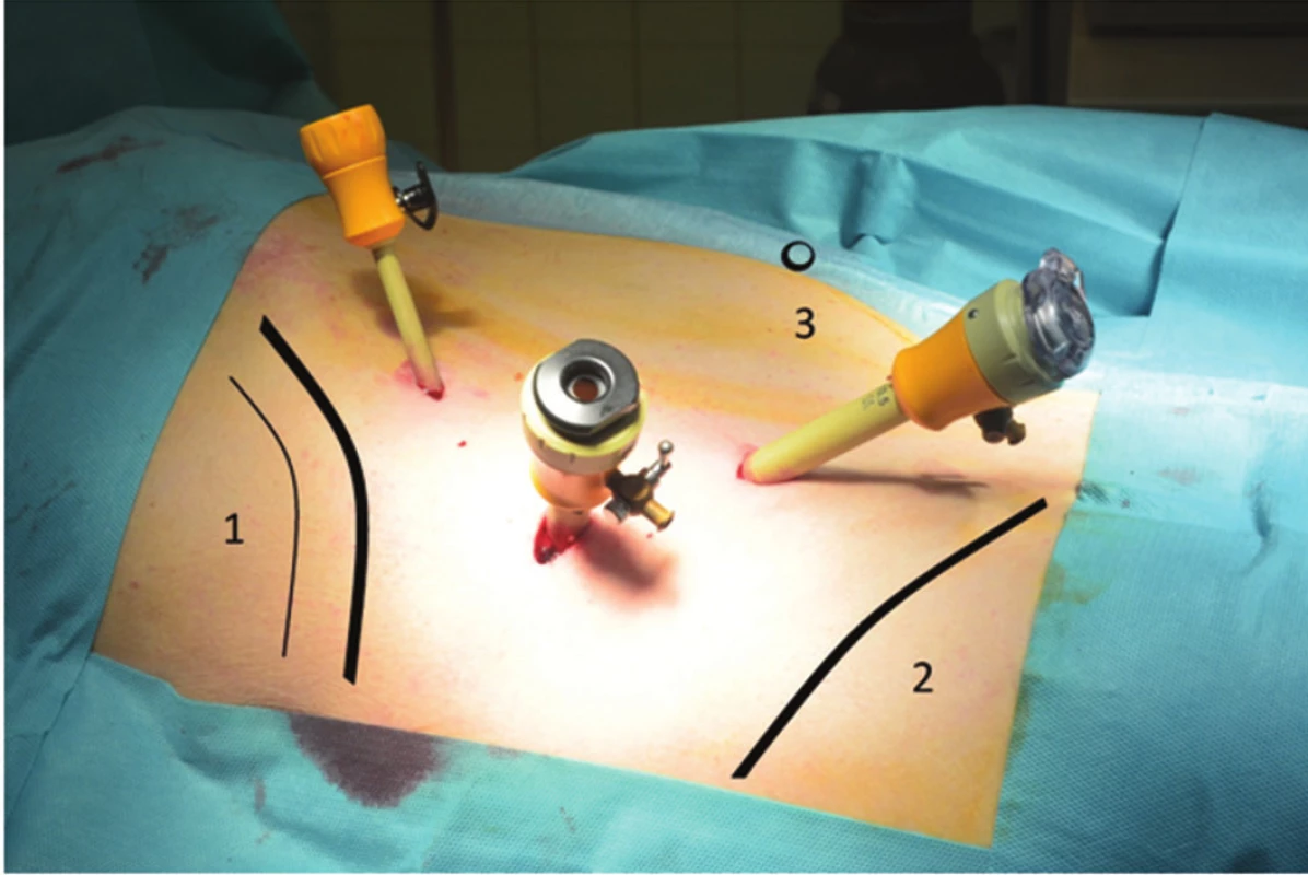 Operačná poloha u LS (1 – costae, 2 – crista iliaca, 3 – umbilicus)
Fig. 1. Surgery position in lumbar sympathectomy (1 – costae, 2 – crista iliaca, 3 – umbilicus)
