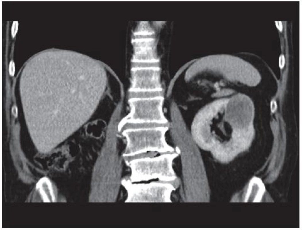 CT vyšetření suspektní expanze levé ledviny
Fig. 1. CT examination-suspicious expansion of the left kidney