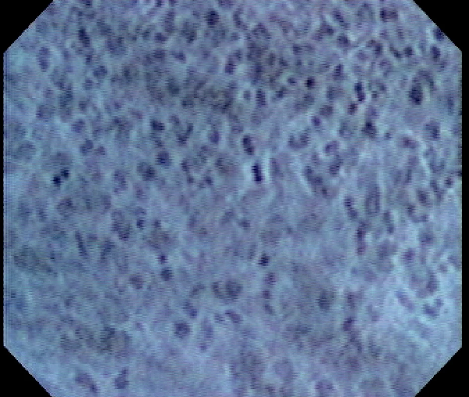 Endocytoskopický obraz karcinomu žaludku