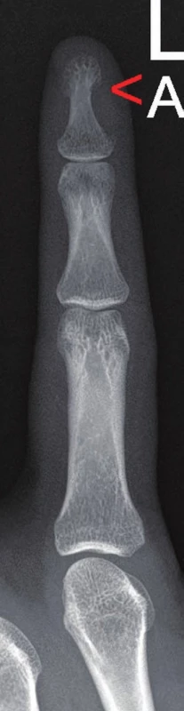 Zadopřední rentgenový snímek 2. prstu. šipka ukazuje místo usurace nehtové drsnatiny distálního článku