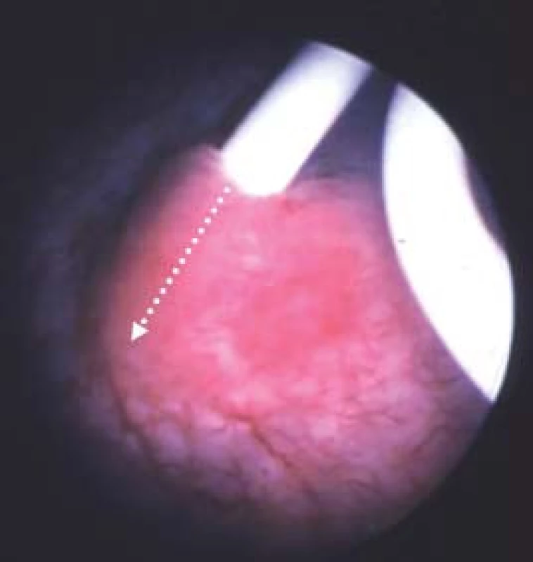 Zavedení ureterálního stentu na počátku operace nám pomůže zvolit místo, kde provedeme incizi (bílá šipka) při antegrádní endopyelotomii.