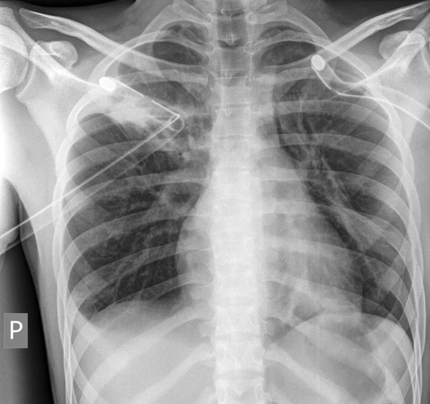 Skiagram plic po založení bilaterální hrudní drenáže – plíce plně rozvinuty