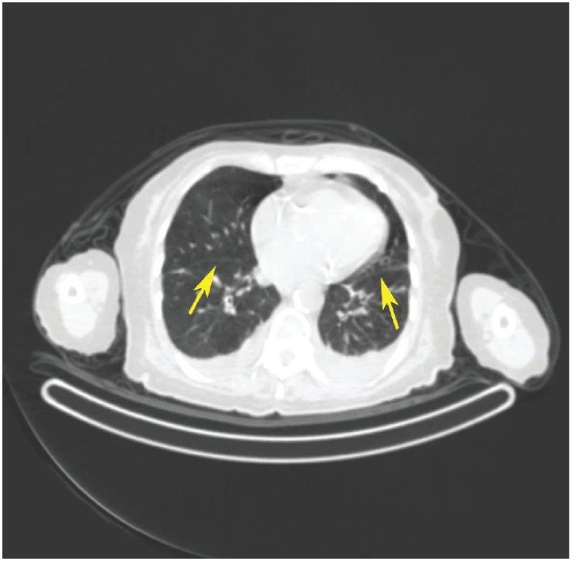 Příčný low dose CT řez hrudníkem. Šipky ukazují CT obraz štěrbin mezi plicními laloky.