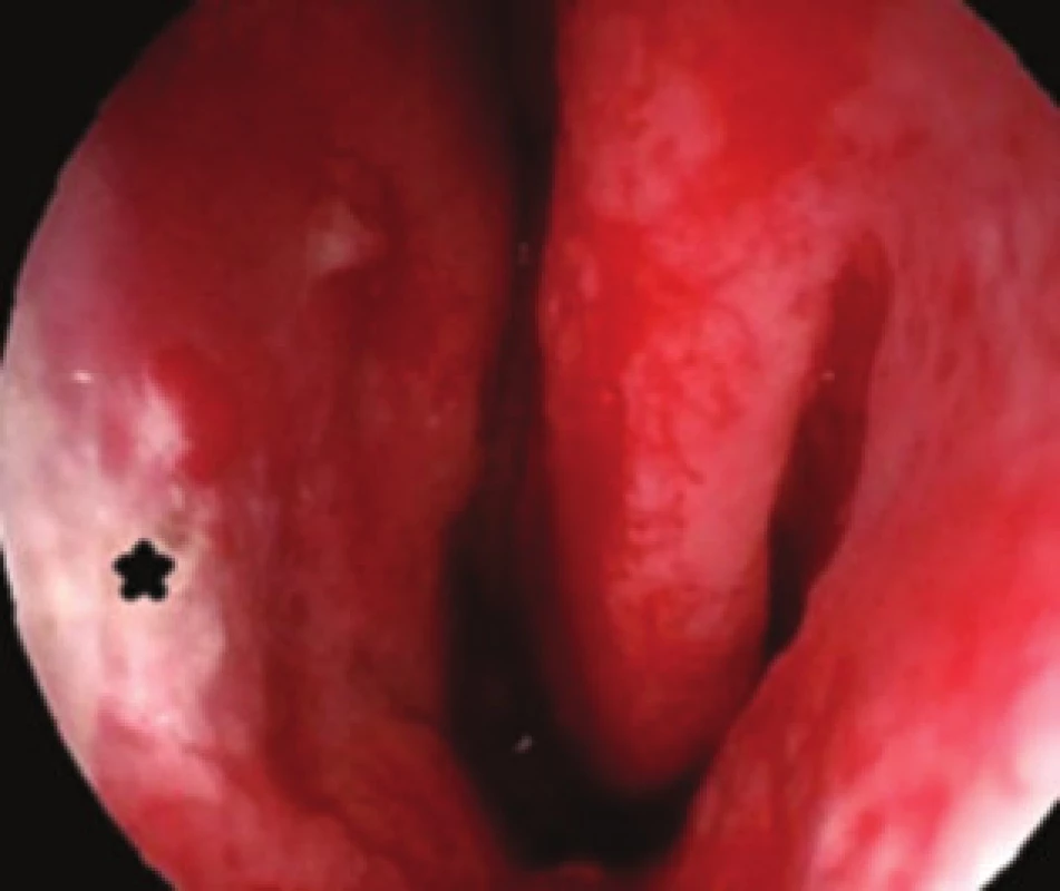 Endoskopický pohled do levé nosní dutiny s atrofickou sliznicí na nosní přepážce (*). Tento obraz se může vyskytnout i po dlouhodobé aplikaci lokálních kortikosteroidů.
