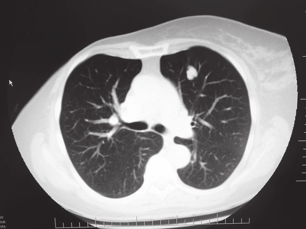 Infiltrace na rozhraní segmentů S4/5 vlevo
Fig. 1: Infiltration of the lung parenchyma between the S4/S5 segments on the left
