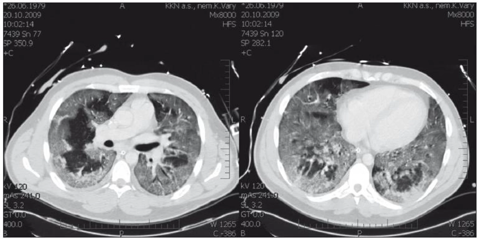 Vstupní CT nález u nemocného s chřipkou H1N1 s hypoxemickým respiračním selháním – nejtěžším postižením plic.