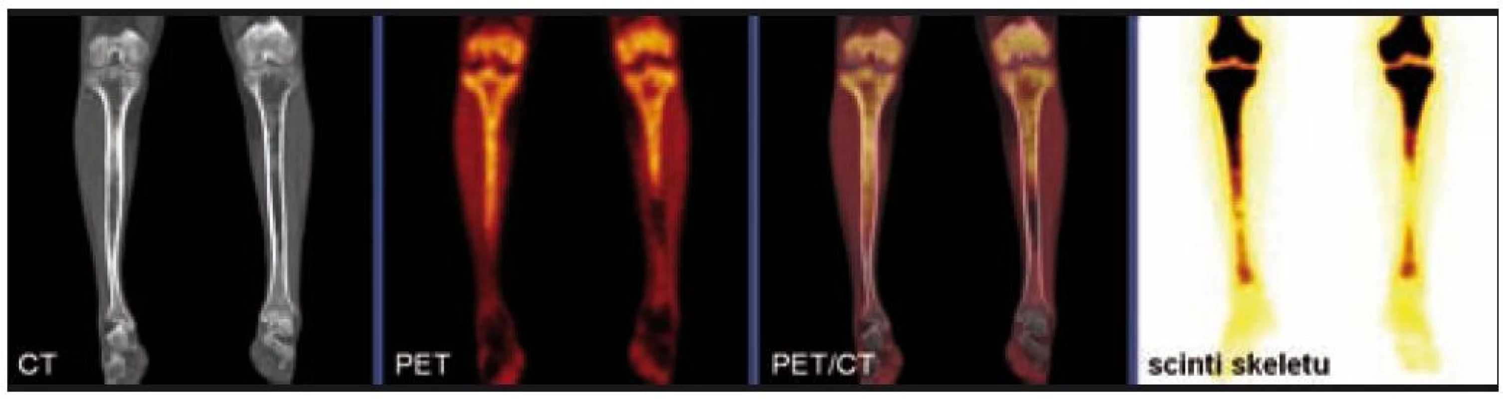 Srovnání nálezů na CT, PET a klasické kostní scintigrafii u pacienta s Erdheimovou-Chesterovou chorobou.

Na CT je patrná nepravidelná sklerotizace dřeňové dutiny obou stehenních i holenních kostí vyjma krátkého úseku střední třetiny levé tibie. V PET obrazu se zobrazila ložiska patologického hypermetabolizmu glukózy v proximálních částech obou tibií (více vpravo), kde byla zároveň popsána patologická akumulace radiofarmaka i na celotělovém scintigramu skeletu.