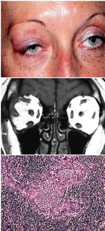 a. Temporální vyklenutí horního víčka tumorem z oblasti slzné žlázy vpravo
b. MR: tumorózní infiltrace slzné žlázy a jejího okolí vpravo
c. Histologie:MALT-lymfom, parafin. řez, barvení hematoxylin- eosin, zvětšení 125krát