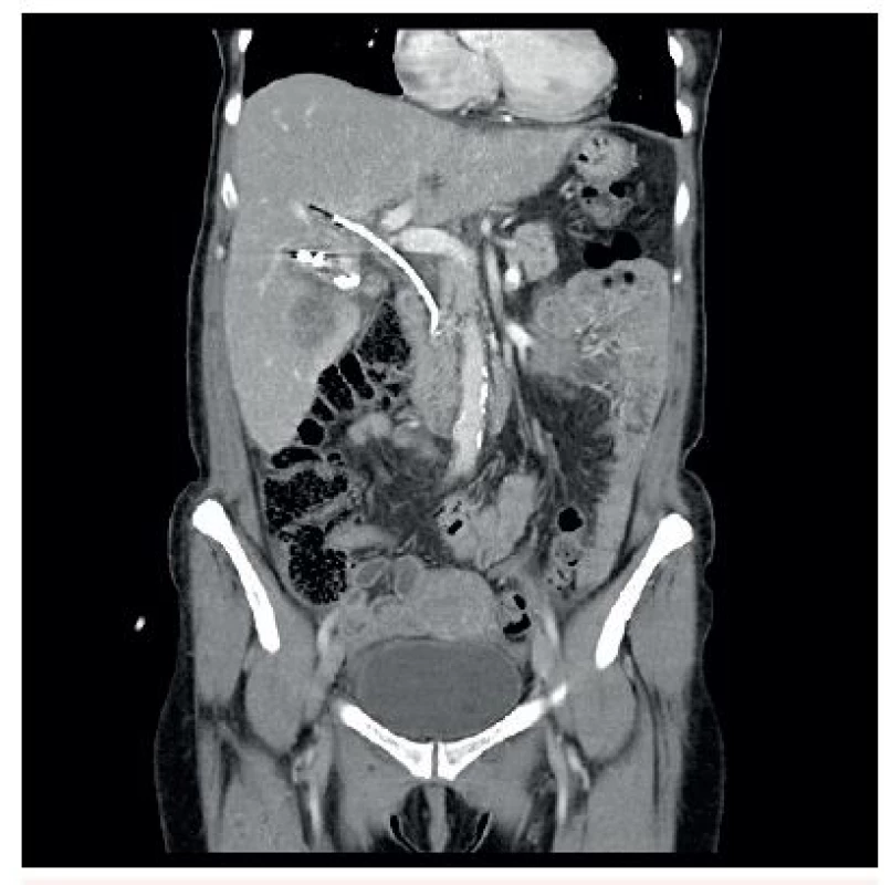 CT břicha s kontrastní látkou v portální fázi, koronární rovina, stav po drenáži pod CT, viditelný plastikový stent ve žlučových cestách