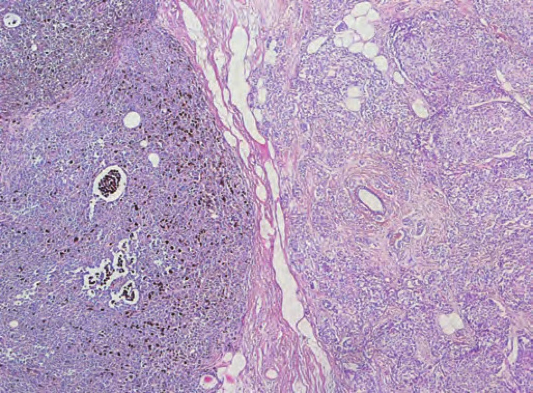 Metastáza melanomu s pigmentem (vlevo) a invazivní duktální karcinom (vpravo). Hematoxylin &amp; eosin, originální zvětšení 100x.