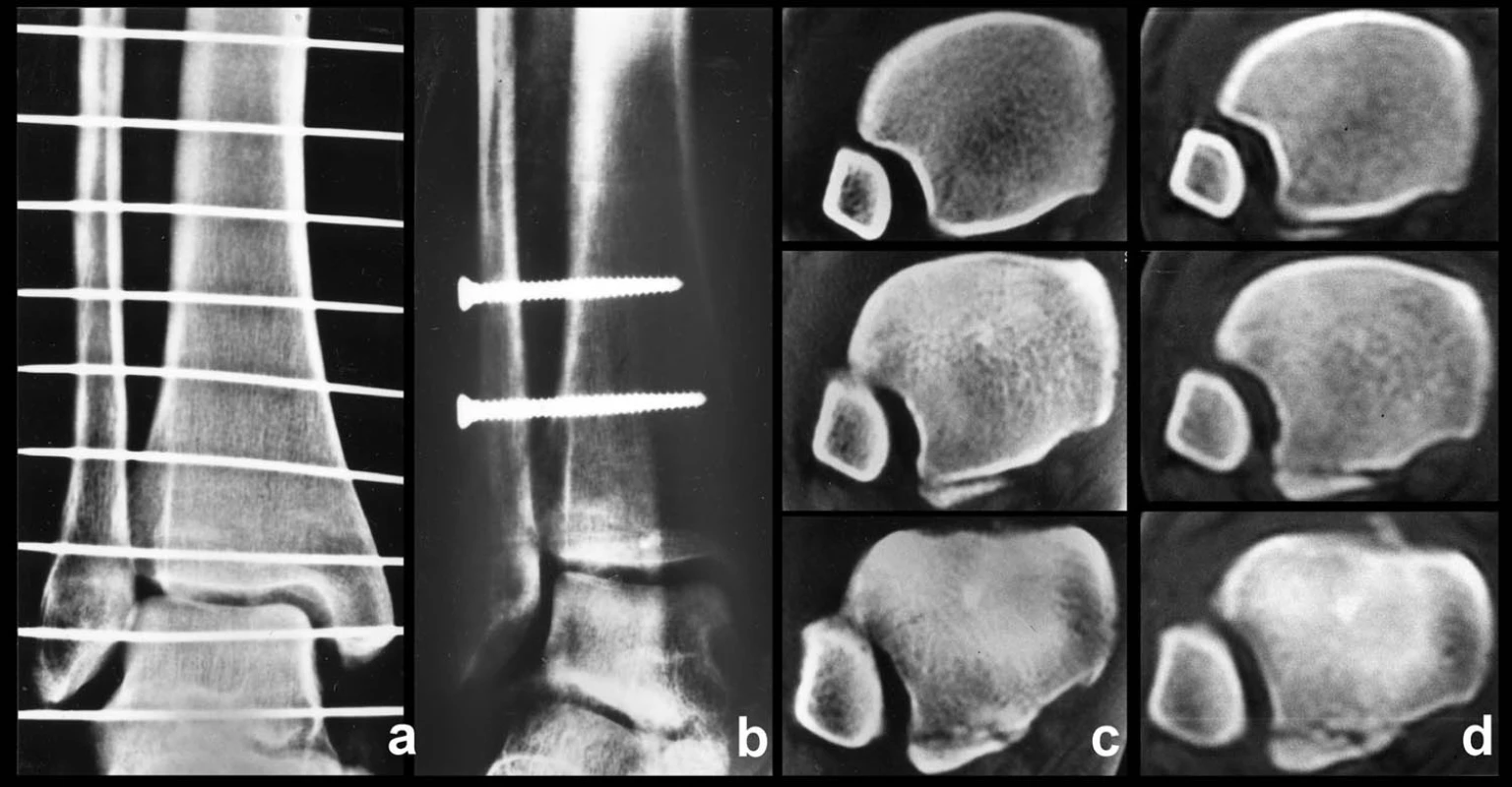 Nedostatečná repozice a fixace fibuly do incisury tibie u Maisenneuveho zlomeniny a – rtg snímek před operaci, b – rtg snímek po operaci, c – CT před operací, d – kontrolní CT po operaci s odlomením zadní hrany typu 1. Ze snímků je patrné, že na rtg přetrvává zkrácení a malrotace fibuly, suprasyndesmální šrouby byly zavedeny příliš vysoko a na pooperačním CT přetrvává subluxace fibuly ventrálně