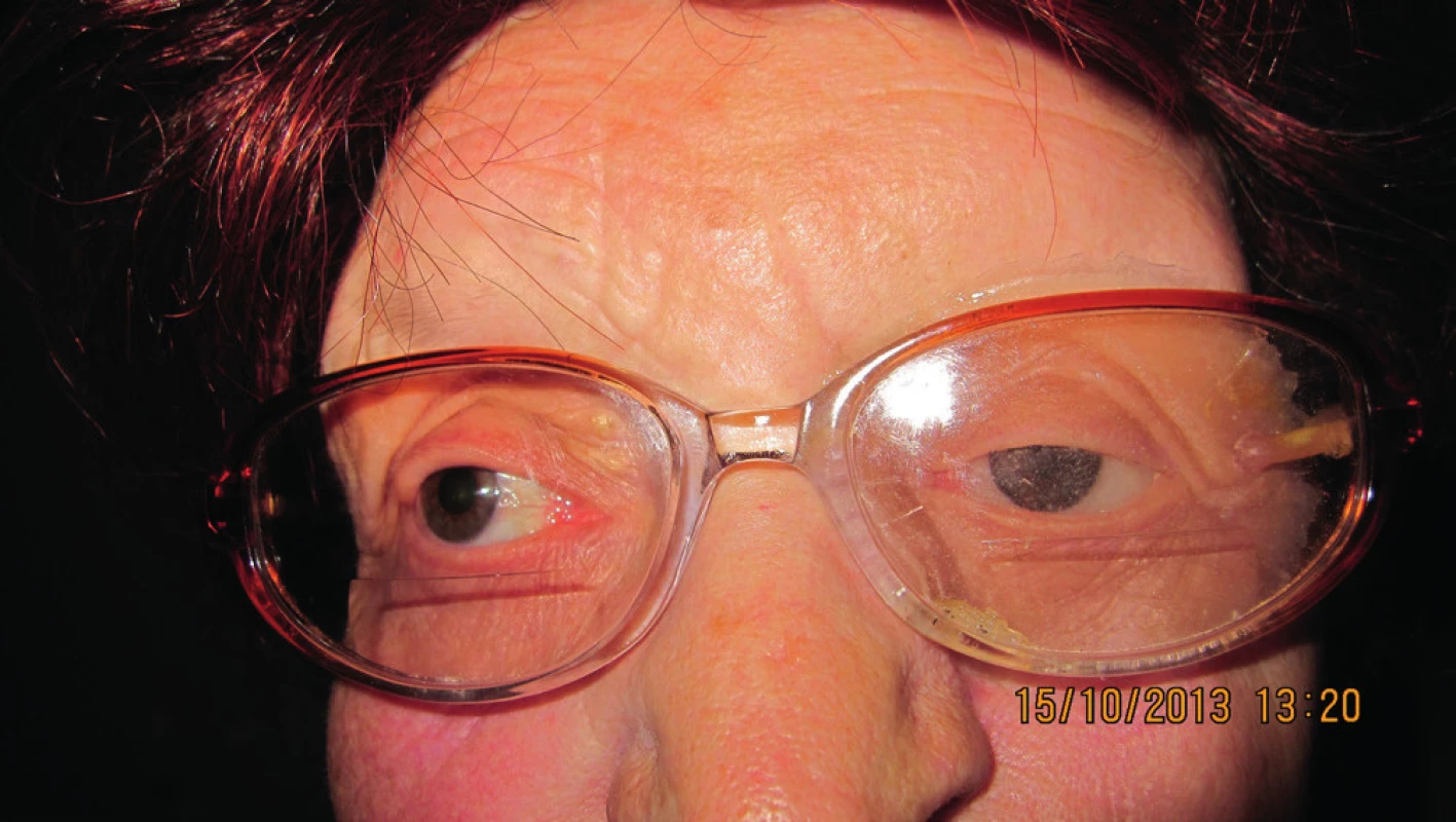 Pacientka s nasadenou epitézou v ráme okuliarov (10/2013)