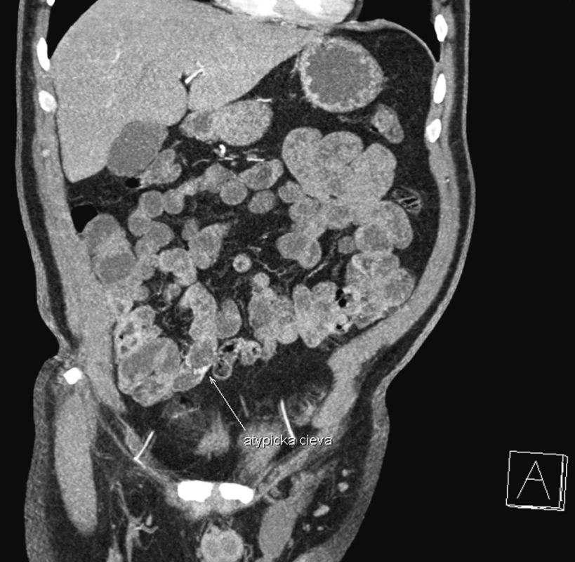 CT enterografia – snímok zachytávajúci cievnu malformáciu na terminálnom ileu (frontálny rez)
Fig. 1. CT enterography – a view depicting a vascular malformation in the terminal ileum (frontal section)