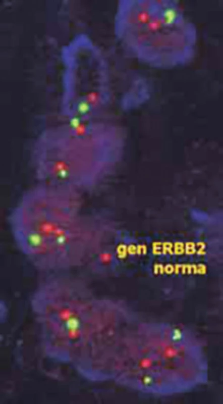 Při vyšetření amplifikace genu HER2 pomocí FISH slouží centromerická oblast 17. chromozomu jako referenční hodnota počtu chromozomů. Pokud není amplifikace přítomna, nepřevyšuje počet signálů HER2 (červené) v jednotlivých buňkách počet centromerických signálů (zelené) více než 1,8× (dle www.patologie.info.cz)