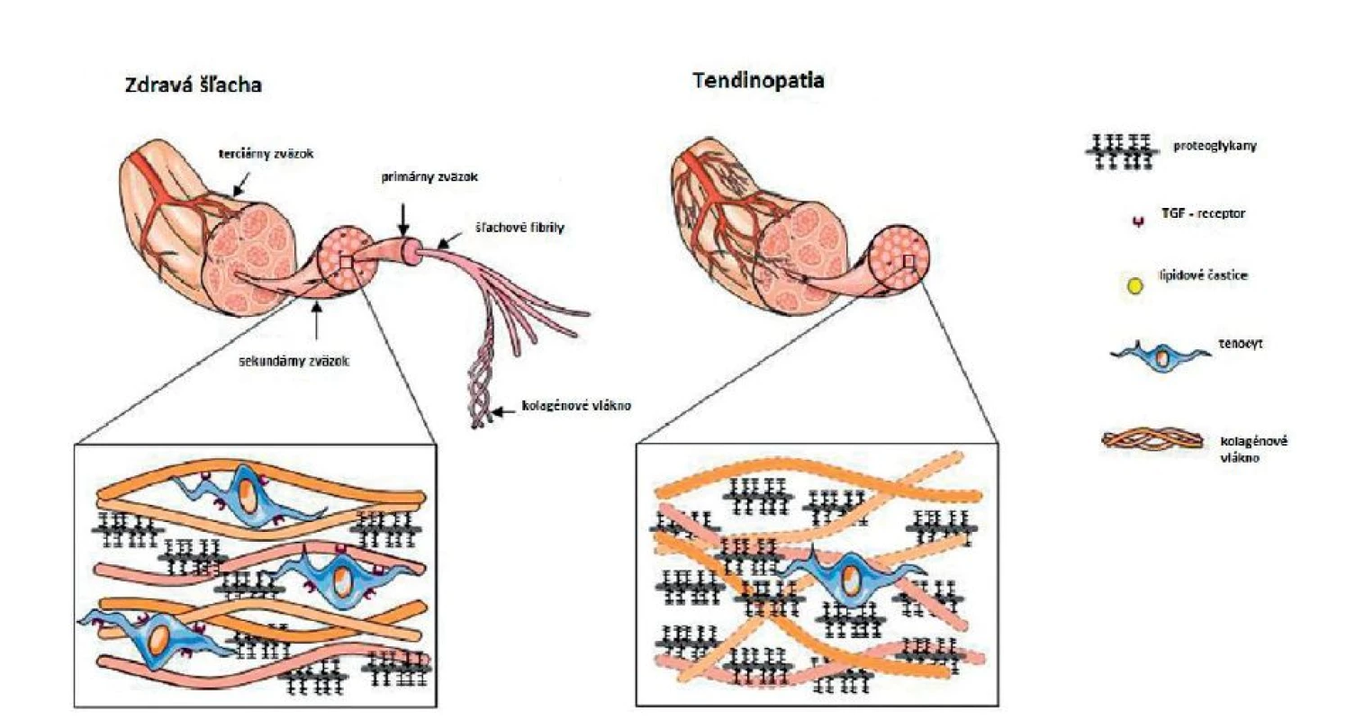 Štrukturálne zmeny medzi zdravým tkanivom šľachy a tendinopatiou.