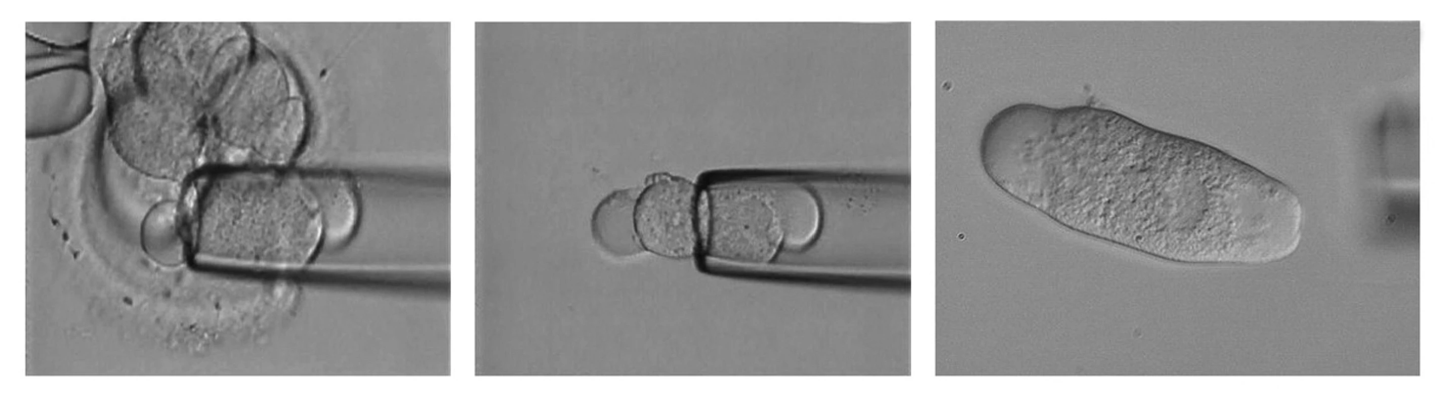 &lt;i&gt;Odběr blastomey z časného embrya.&lt;/i&gt; A – nasávání 1 blastomey uvnitř embrya do bioptické pipety, B – uvolnění blastomey z bioptické pipety do média, C – odebraná blastomea určená pro PCR PGD s patrným buněčným jádrem.
