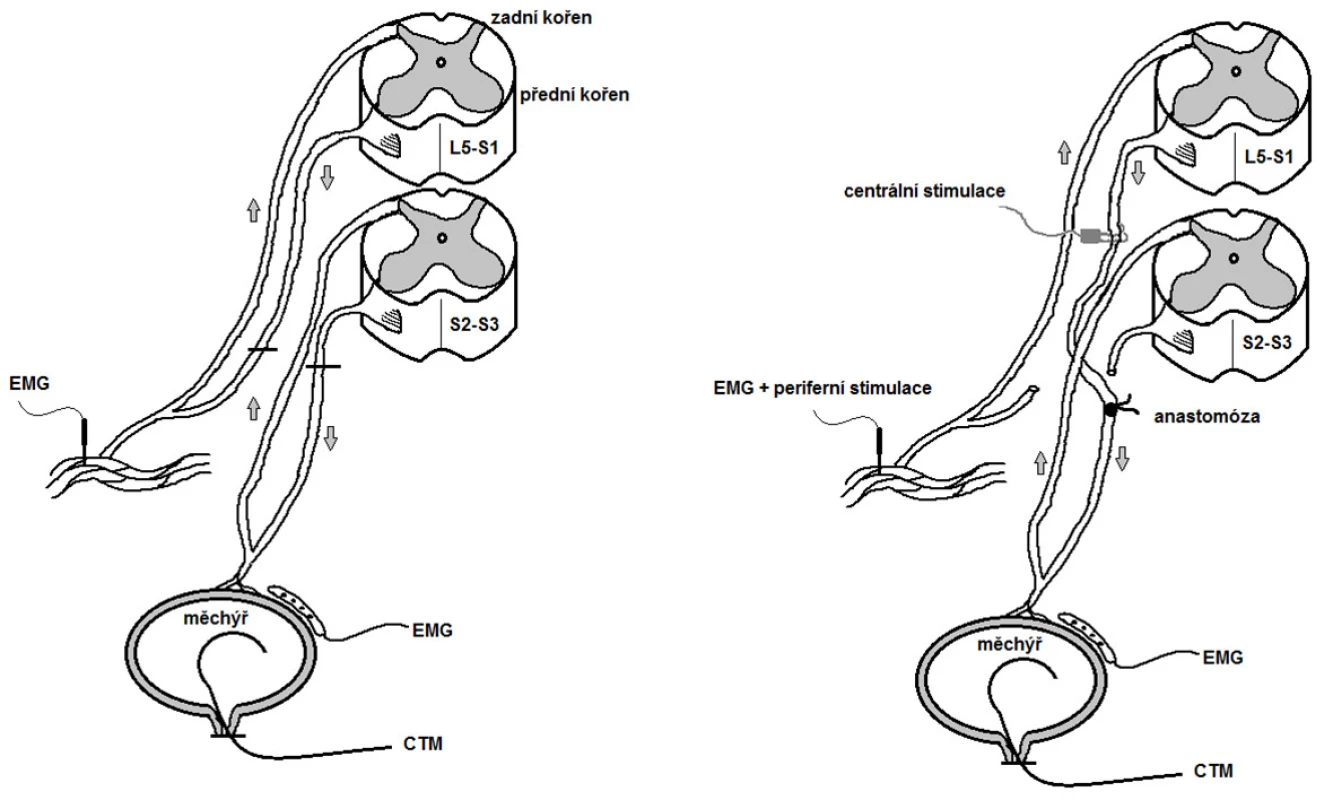 Schéma arteficiálního mikčního reflexního oblouku. Vlevo výchozí stav, vpravo po anastomóze předních kořenů
Fig. 1. Scheme – artificial micturition reflex arc. Left – before surgery, right – after ventral root anastomosis