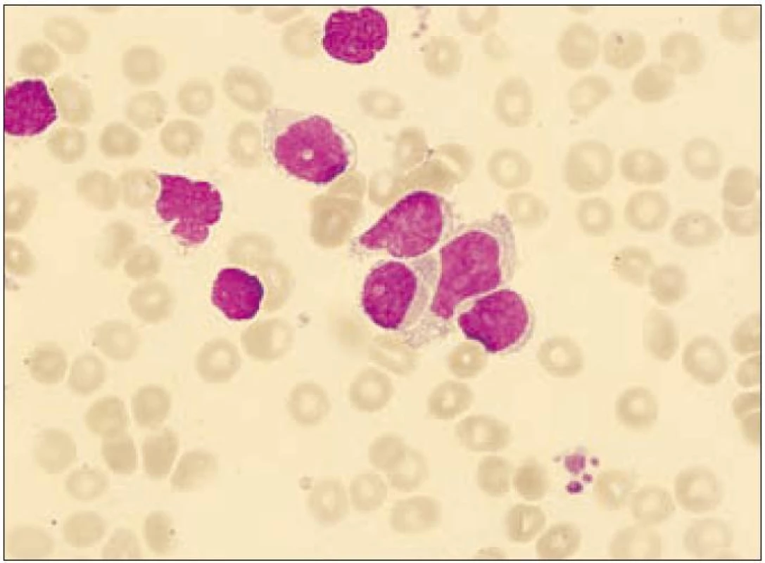 Nátěr kostní dřeně (případ 1) při leukemizaci onemocnění. Na snímku několik blastických elementů s objemnější jemně vakuolizovanou cytoplazmou.