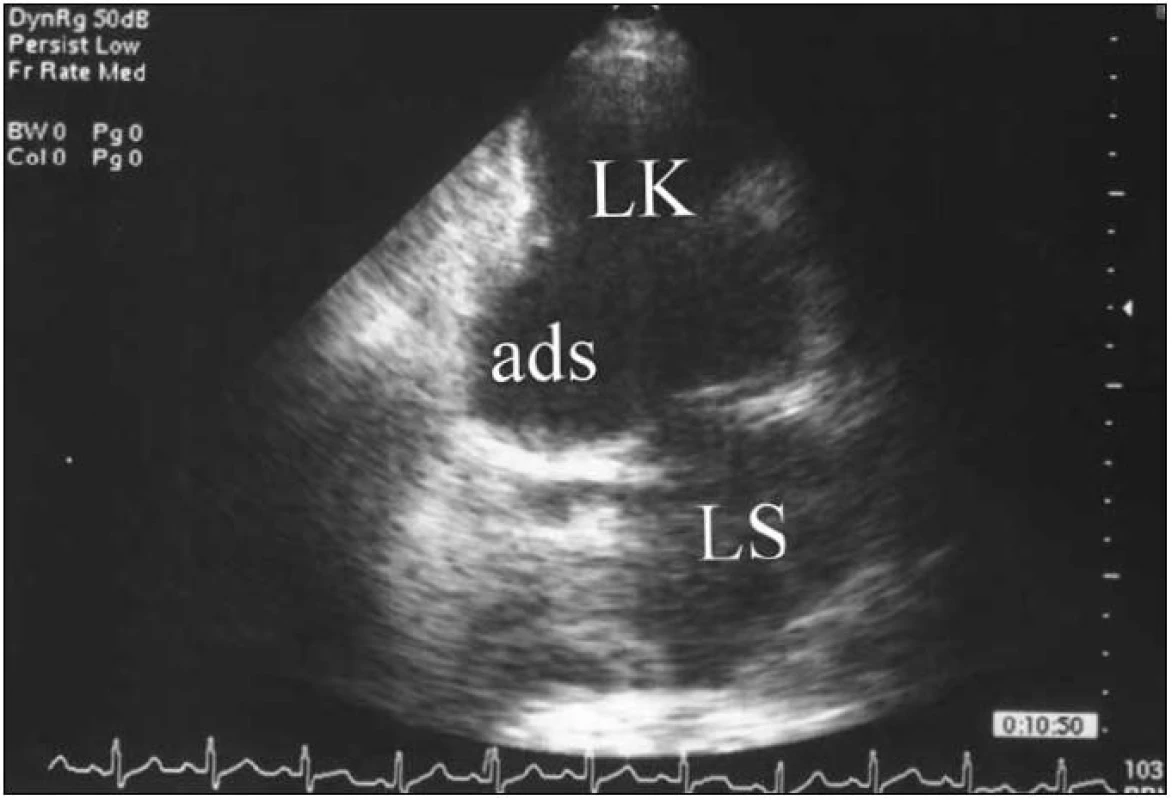 Aneuryzma dolní stěny levé komory.
LK – levá komora, LS – levá síň, ads – aneuryzma dolní stěny LK.