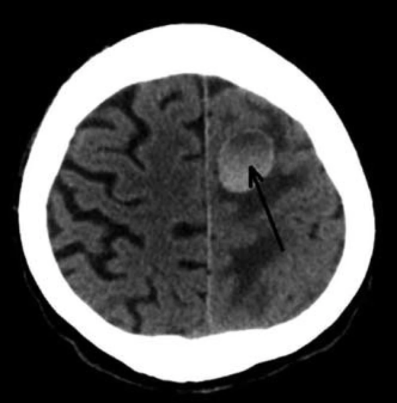 CT mozku – metastatické postižení CNS (šipka).
Fig. 12. Brain CT scan – brain metastatic leasion.