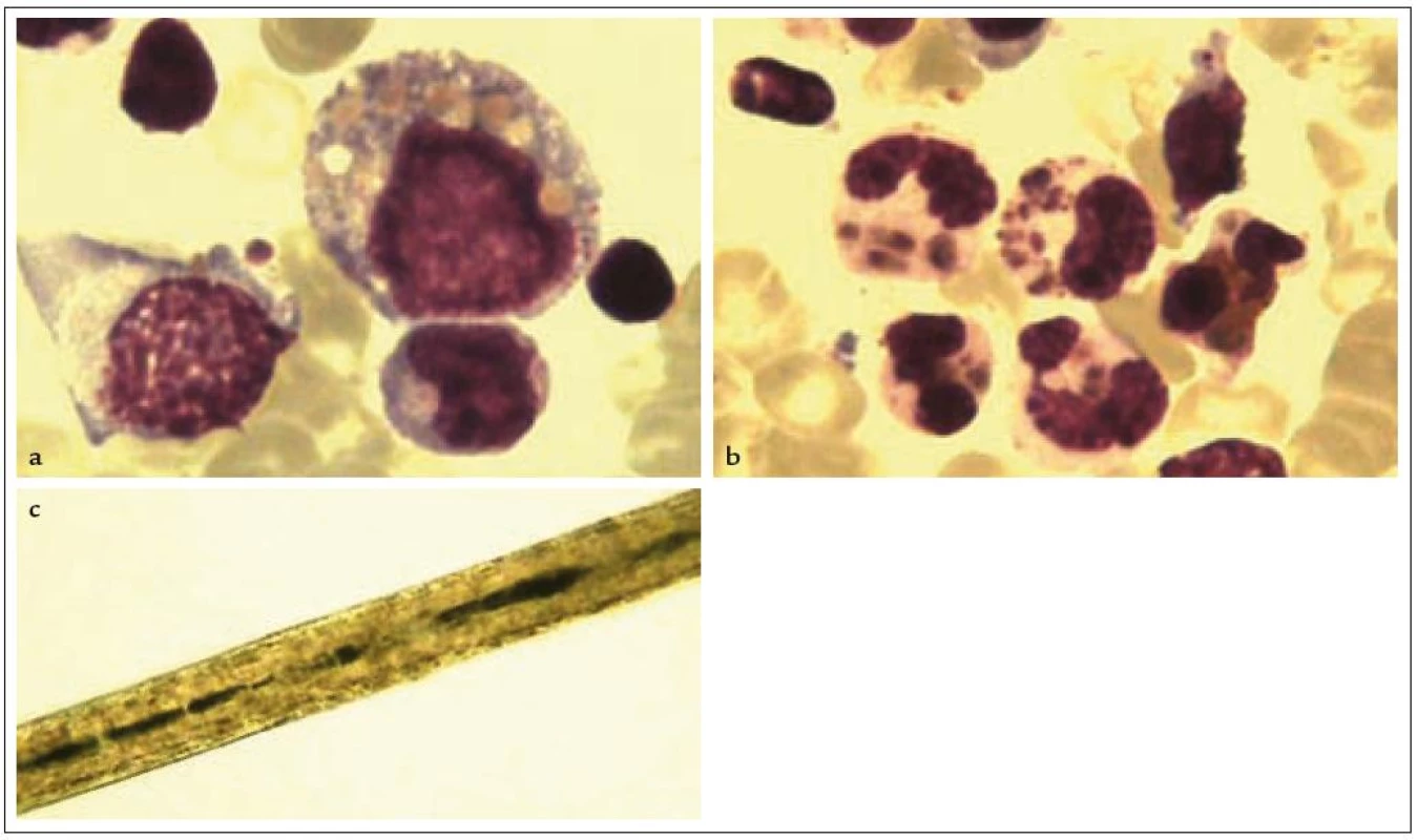 Chédiak- Higashiho syndrom.
3a: Monocyt s charakteristickými inkluzemi ve vakuolách, eozinofi l s atypickou granulací.
3b: Neutrofi lní segment s atypickou granulací (barvení dle Pappenheima, zvětšeno 1 000krát).
3c: Vlas s akumulací abnormálně velkých melanozomů.