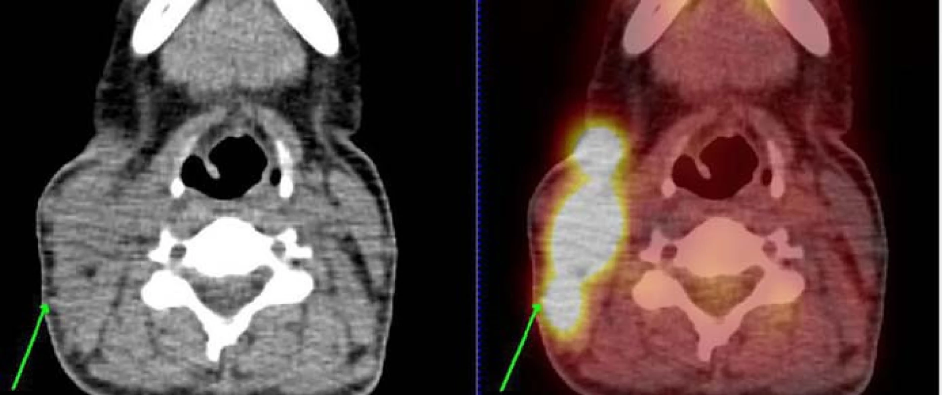 PET/CT nález leden roku 2011 v době stanovení diagnózy. Obrázek vztahující se ke kazuistice č. 2. U pacientky je patrná významná kumulace radioaktivní glukózy v tkáních na pravé straně krku svědčící pro vysokou metabolickou aktivitu tkáně.