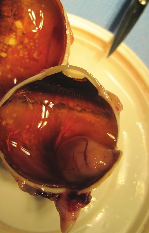 Pacient č. 1 - Makrofoto enukleovanej očnej gule po enukleácii pre MMCH; histopatologicky sa jedná o vretenobunkový typ B, ktorý prerastá do povrchu steny bulbu, bez propagácie do n. opticus