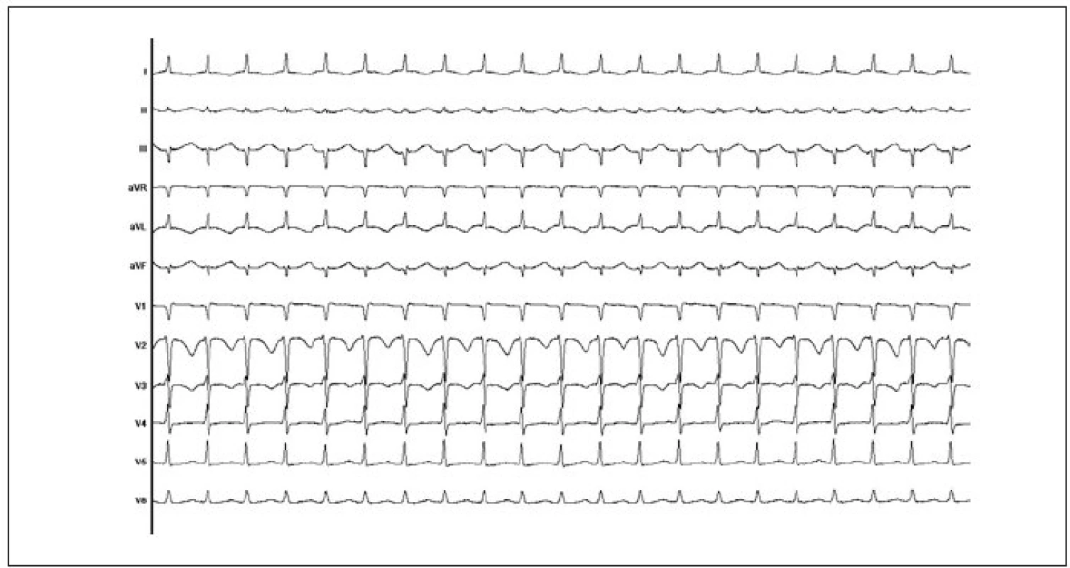 12svodový záznam EKG typické AVNRT. Vlna P se zapisuje v terminální části komplexu QRS, a vytváří tak obraz tzv. pseudo-r' ve svodu V1 (tj. nejde o skutečný kmit r', který by odpovídal poruše depolarizace komorové svaloviny).