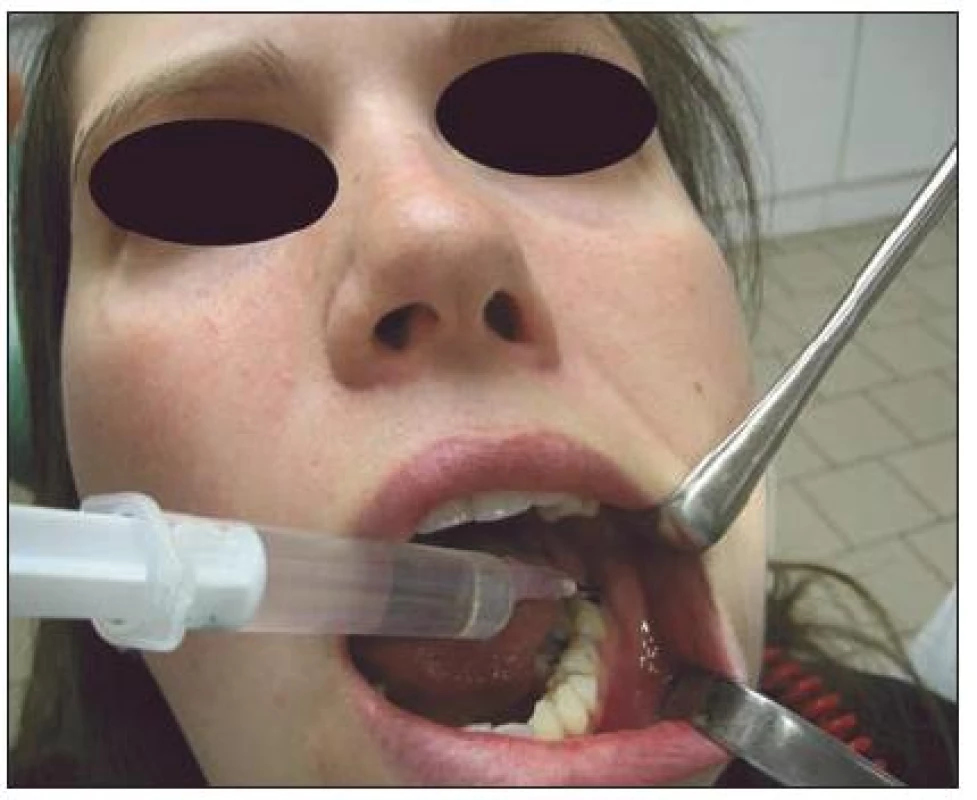 Výplach nečistot z prázdného zubního lůžka 38 pomocí 3% H&lt;sub&gt;2&lt;/sub&gt;O&lt;sub&gt;2&lt;/sub&gt;