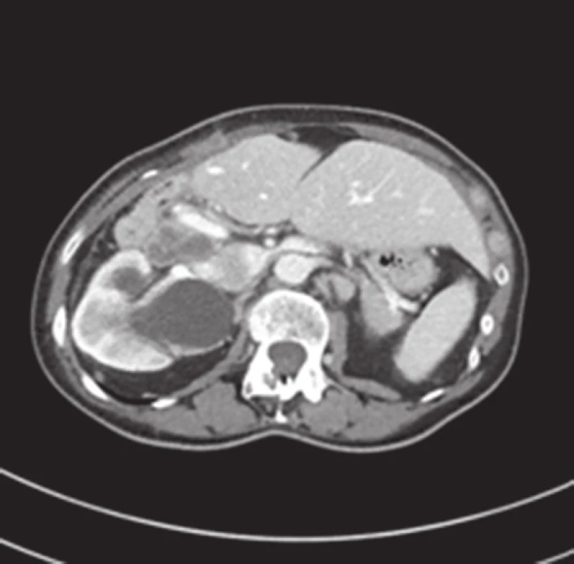 CT obraz infiltrace lymfatických uzlin hepatoduodenálního ligamenta goblet-cell karcinoidem (venózní fáze, axiální řez)
Fig. 2: CT scan infiltration of hepatoduodenal lymph nodes with goblet-cell carcinoma (venous phase, axial view)