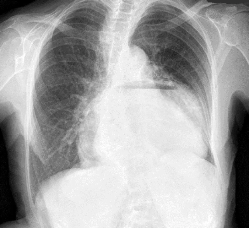 Rtg snímek hrudníku
Fig. 7: X-ray image of the chest