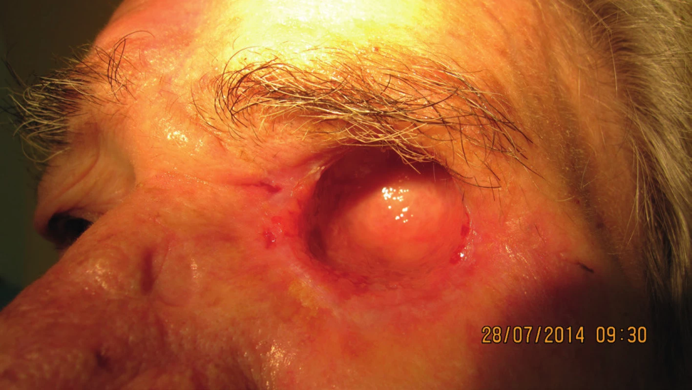 Po exenterácii očnice hojenie bez komplikácií (7/2014)