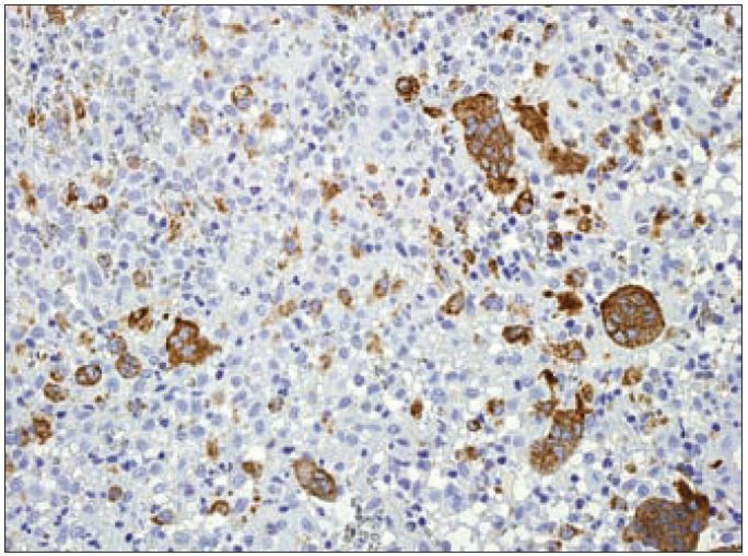 CD68 (PGM- 1) – imunohistochemické vyšetření. Mnohojaderné makrofágy jsou pozitivní silně (hnědý precipitát), mononukleární Langerhansovy buňky jsou pozitivní jen ojediněle, jádra dobarvena hematoxylinem.