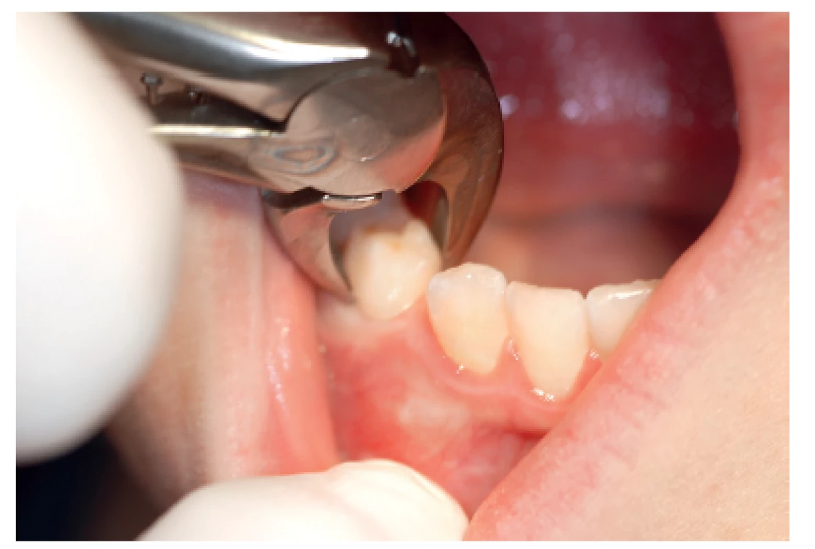 Extrakce zubu 84 u pacienta s hemofilií. Zub 84 před eliminací – ve vestibulu patrné vyklenutí způsobené prořezávajícím se zubem 44