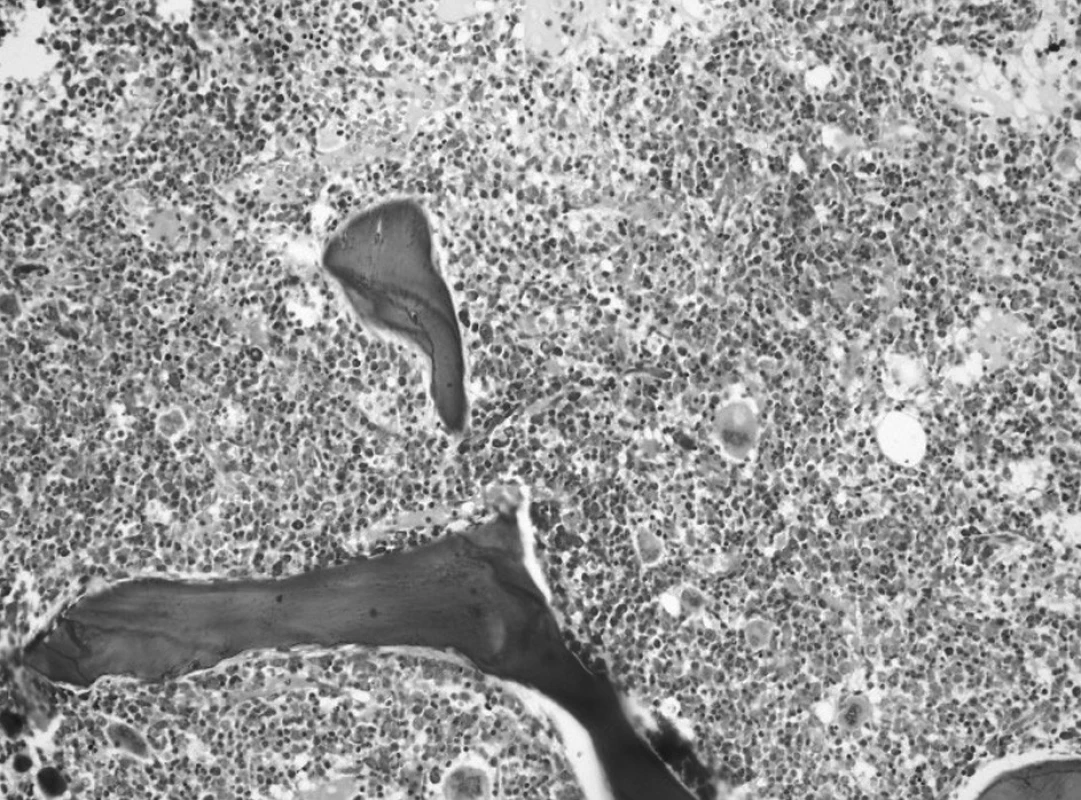Druhé trepanobioptické vyšetrenie: hypercelulárna dreň s črtami myeloproliferatívnych a myelodysplastických zmien (Giemsa, 20x).
Fig. 4. Second trepanobioptic examination: hypercellular bone marrow with marks of myeloproliferative and myelodysplastic changes (Giemsa, 20x).
