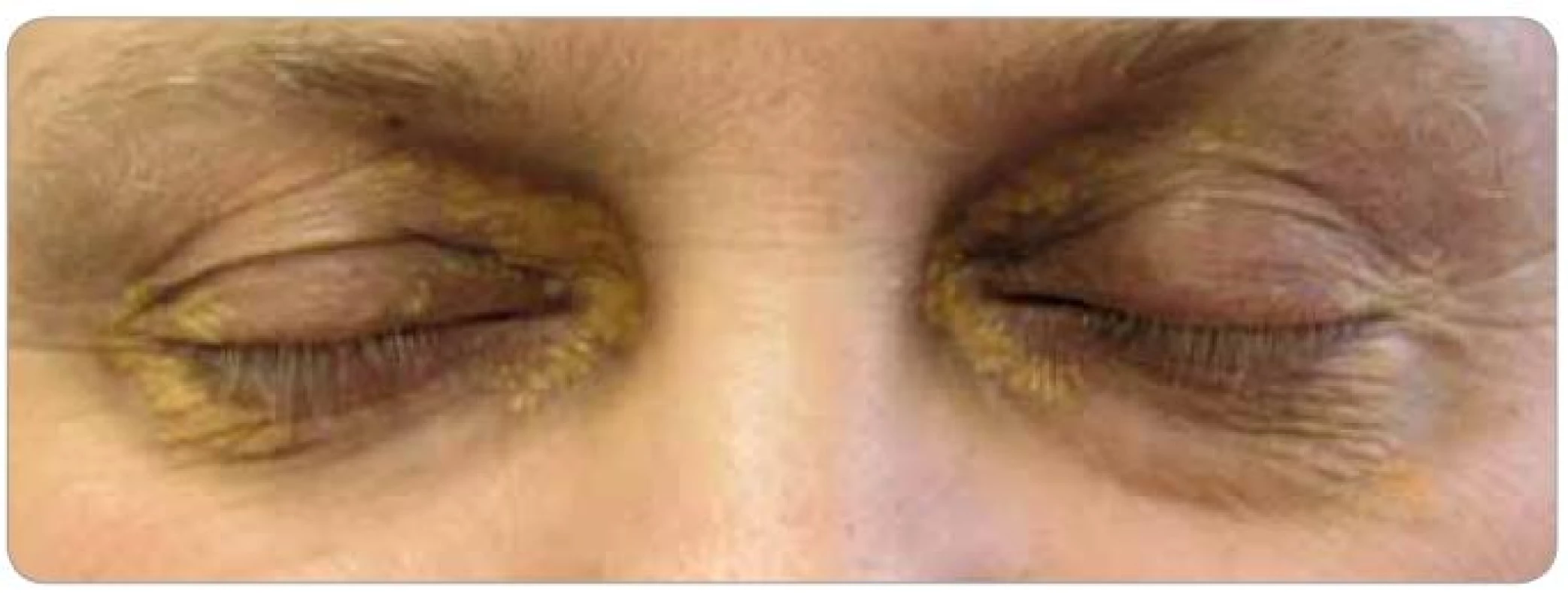 Xantalesma kolem očí pacienta, která se postupně zvětšují.