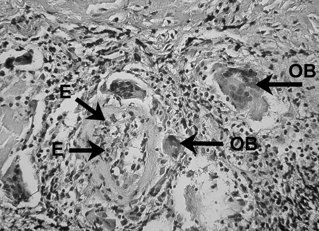 Zápalový bunkový infiltrát prítomný v periapikálnom granulóme V histopatologickom obraze lézie možno vidieť eozinofily (E) a obrovské bunky (OB) – autor Ján Kováč.
Fig. 4. Inflammatory cell infiltrate in periapical granuloma Histopathological image of the lesion shows eosinophils (E) and giant cells (OB) – Author Ján Kováč.