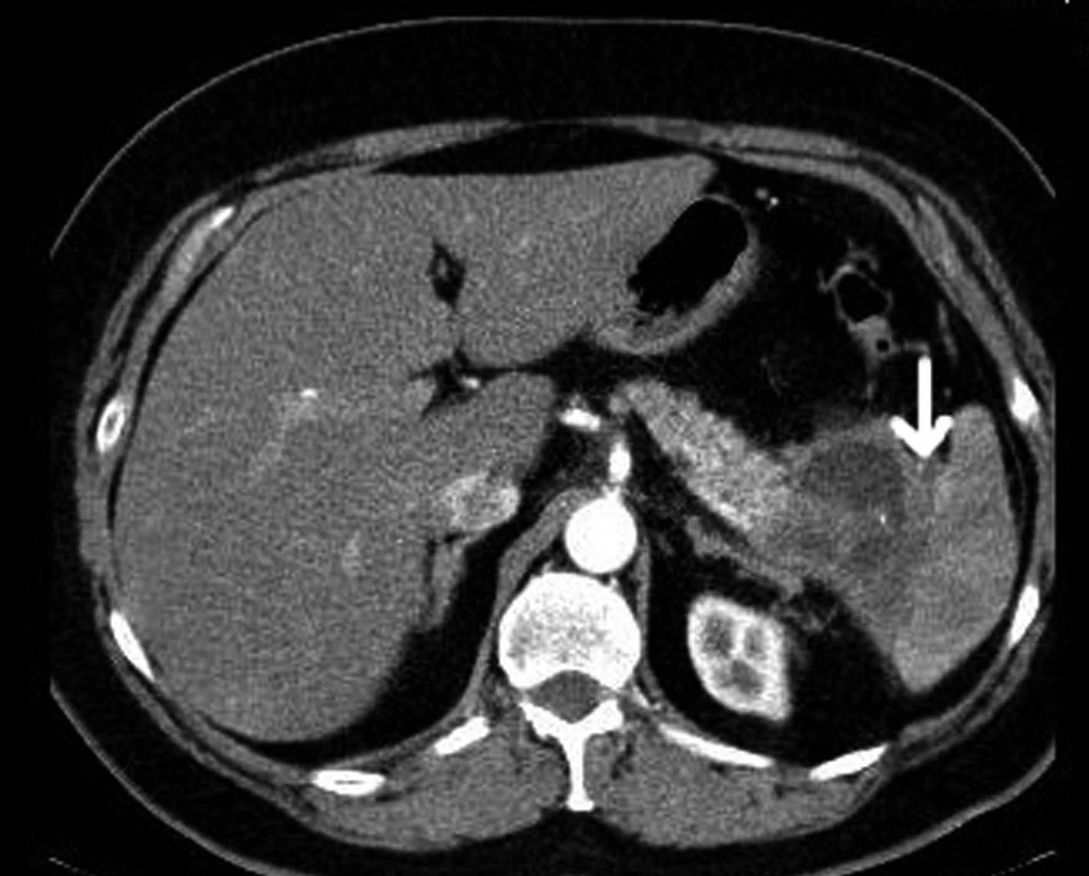 CT s kontrastní látkou i.v. Karcinom kaudy slinivky břišní s infiltrací hilu sleziny (šipka).