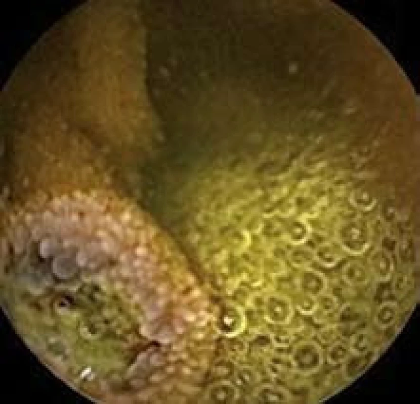 Polyp jejuna, kapslová enteroskopie.
Fig. 2. Polyp in jejunum, capsulle enteroscopy.