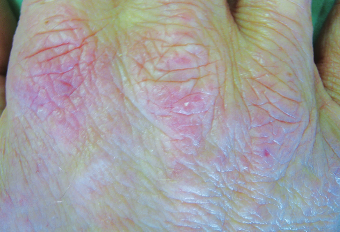 Proteinová kontaktní dermatitida na hřbetech rukou po mase a koření u kuchaře