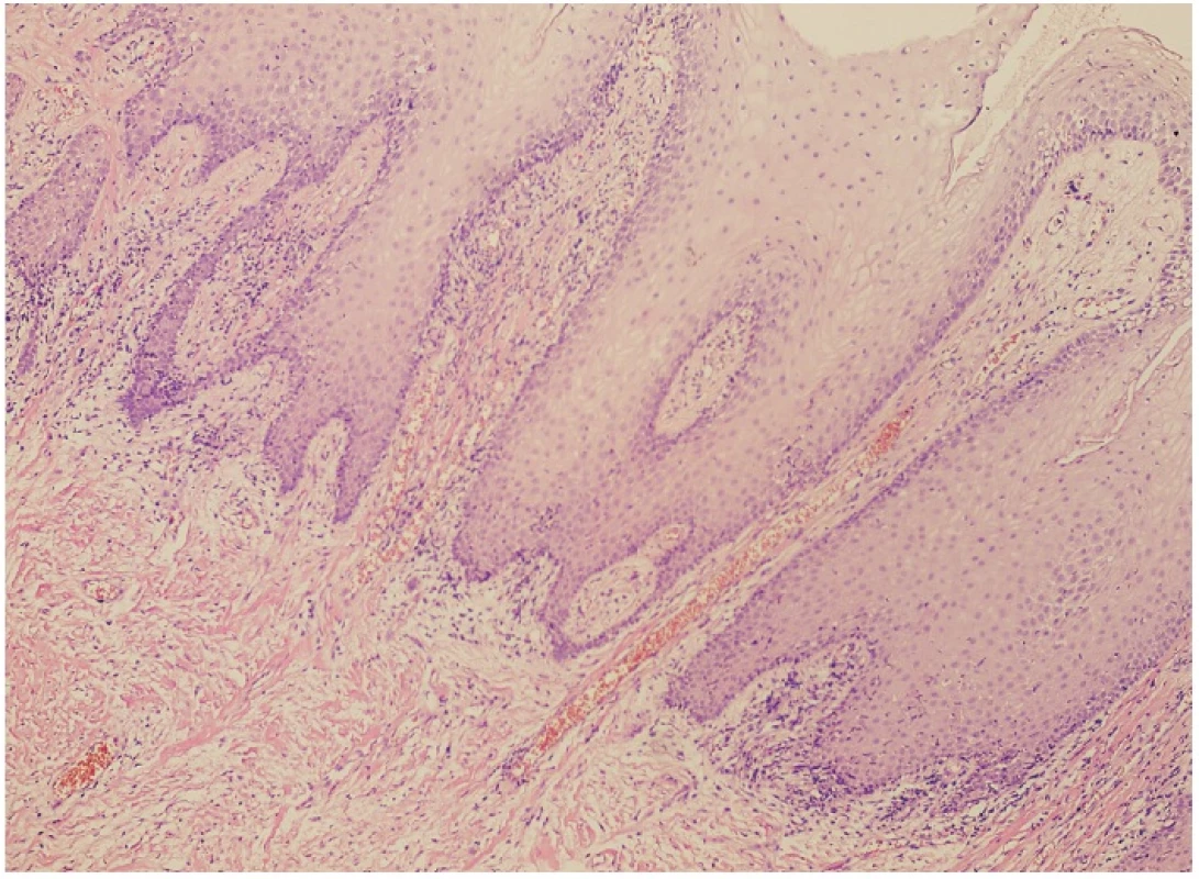 Akantotický dlaždicový epitel s okolitým chronickým nešpecifickým zápalom (farbenie hematoxylín-eozín, zväčšenie 100×)