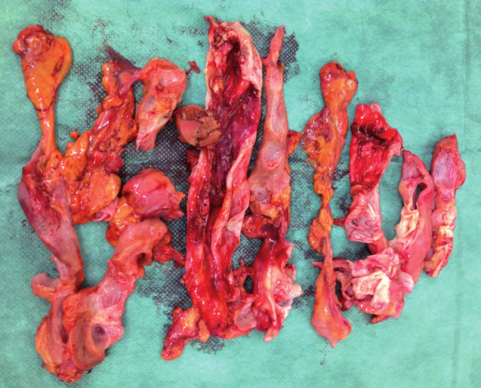 Fragmenty ledviny po morcelaci
Fig. 5. Kidney fragments after morcellation